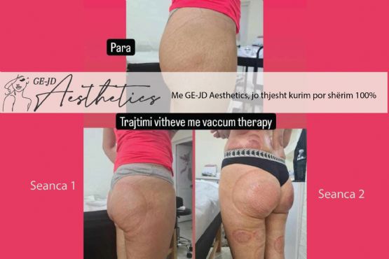 Ngritje vitheve me kupa vaccum therapy, Trajtim i vitheve me vakum, Ngritje vithesh me kupa vakumi, tonifikim trupi,  Anticelulit për gjithë trupin me vakum, Masazh anticelulit per vitheve me masazh dore, Masazh anticelulit 